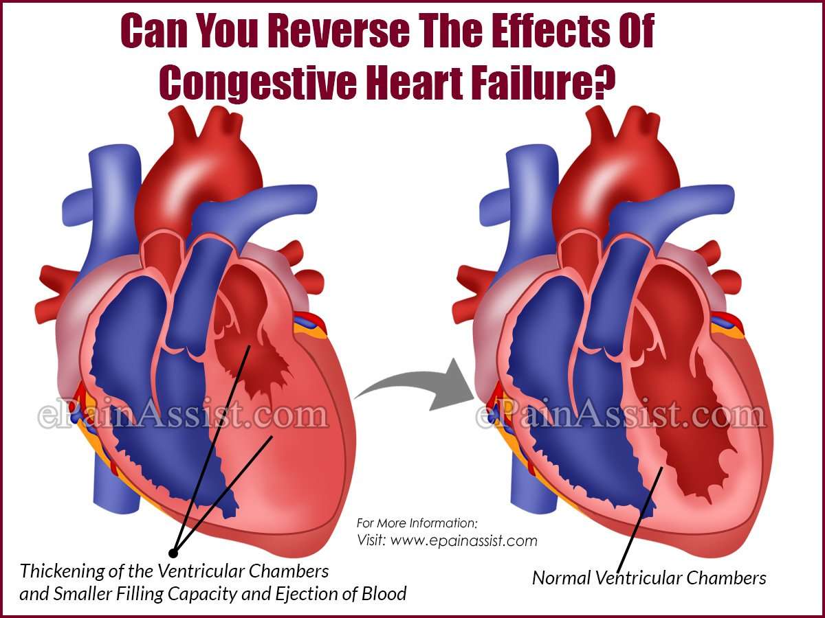 Застойная сердечная недостаточность. Реверс сердца. Время вылечит сердце. Backward Heart failure.
